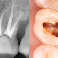 根管治療の歯髄